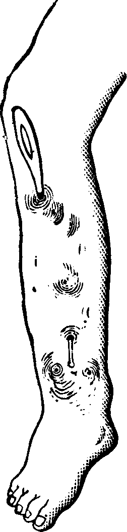 Illustration:
Fig. 6. Necrosis of the tibia. A common probe is passed through the
sinuses, or openings.